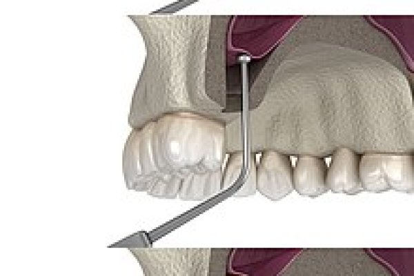 SİNÜS LİFT VE KEMİK ARTIRIMI (GREFTLEME)